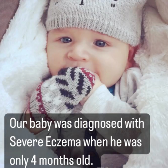 Doctors Said There Was No Cure - Healing Eczema