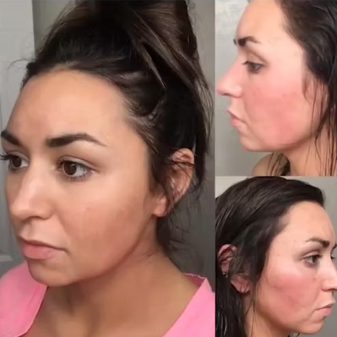 Healed Acne With Medical Medium